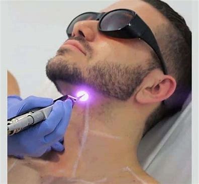 Beard Laser Hair Removal