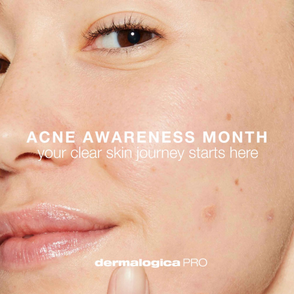 Acne Awareness Month ProClear Tx at Facials with Rachel in Maplewood, MN