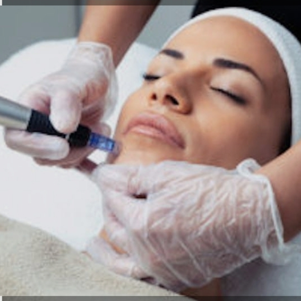 Microneedling Package X3 at let's face it by Ash in Evans, CO