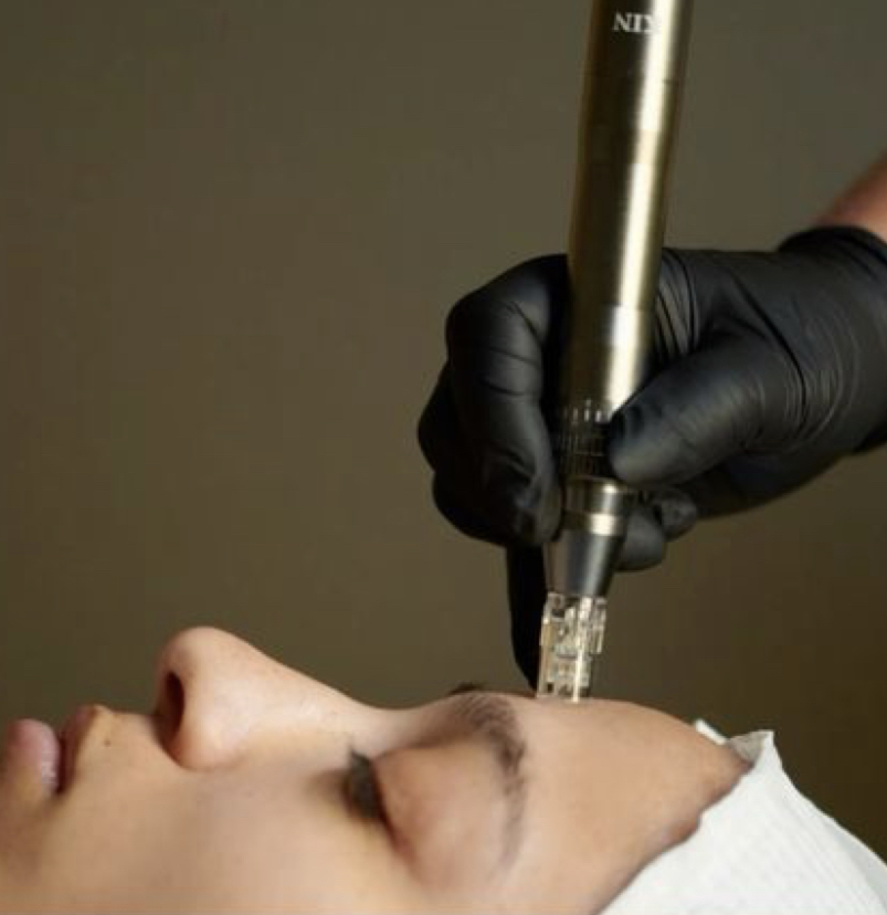 Nano-needling at Grandeur Day Spa in Terre Haute, IN
