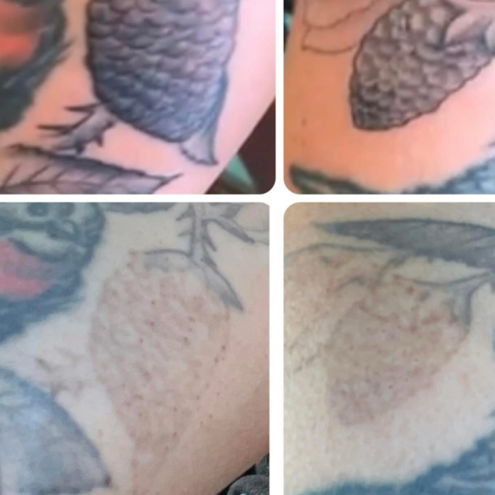 Laser Tattoo Removal at Southern Sparkle Medical Aesthetics in Swainsboro, GA