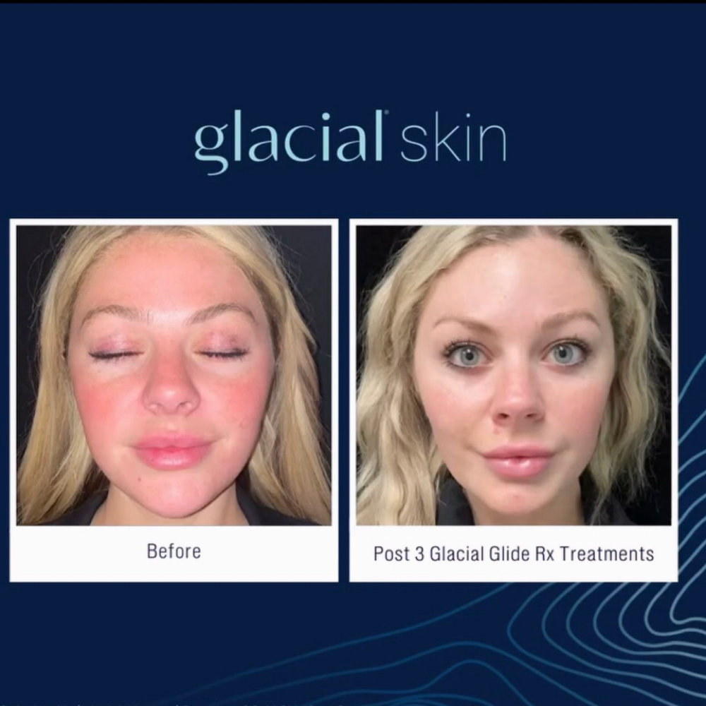 3 Glacial Glide Add-Ons – Save $58 at SKIN CLINIC in Laguna Hills, CA