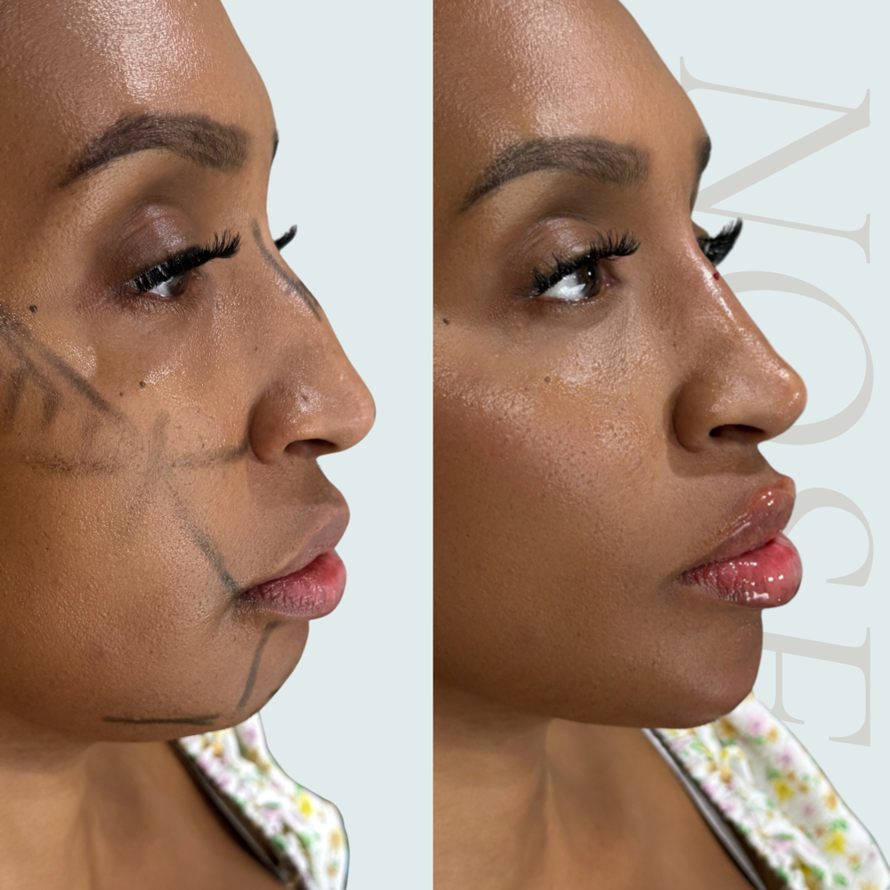 NON SURGICAL RHINOPLASTY REFINEMENT at Klashed NYC in Manhattan, NY