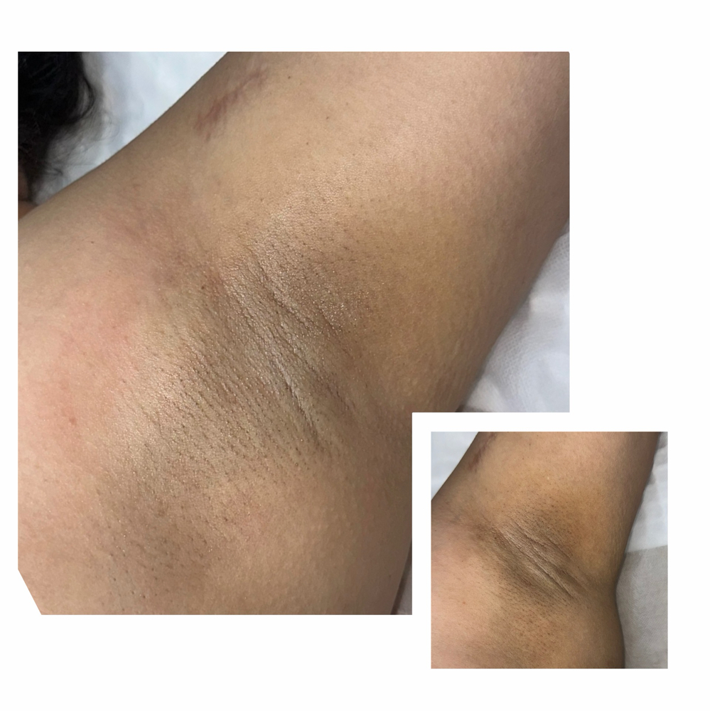 Intimate Brightening at Skin & Beauty Aesthetics Studio in New York, NY