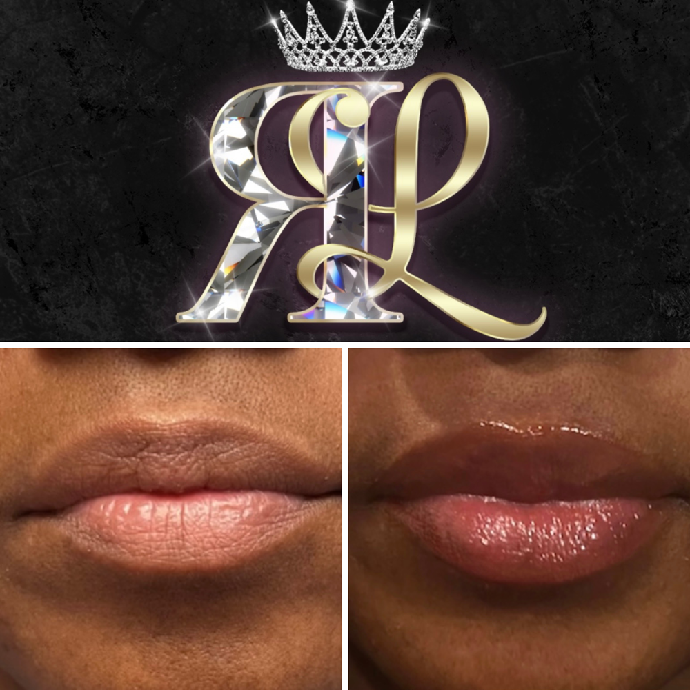 Hyaluron Lip Filler 1.5ML at Royal Luxxe Studios in Colleyville, TX