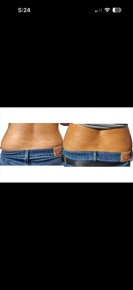 Inkless Stretch Mark Revision/Camo at Jens Ink Tattoo Studio in Sebring, FL