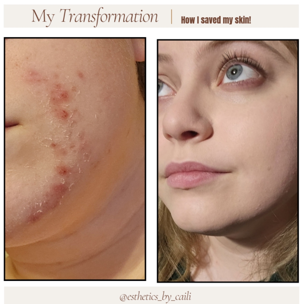 Acne Facial at Jennifer Scott Med Spa in Arnold, MO