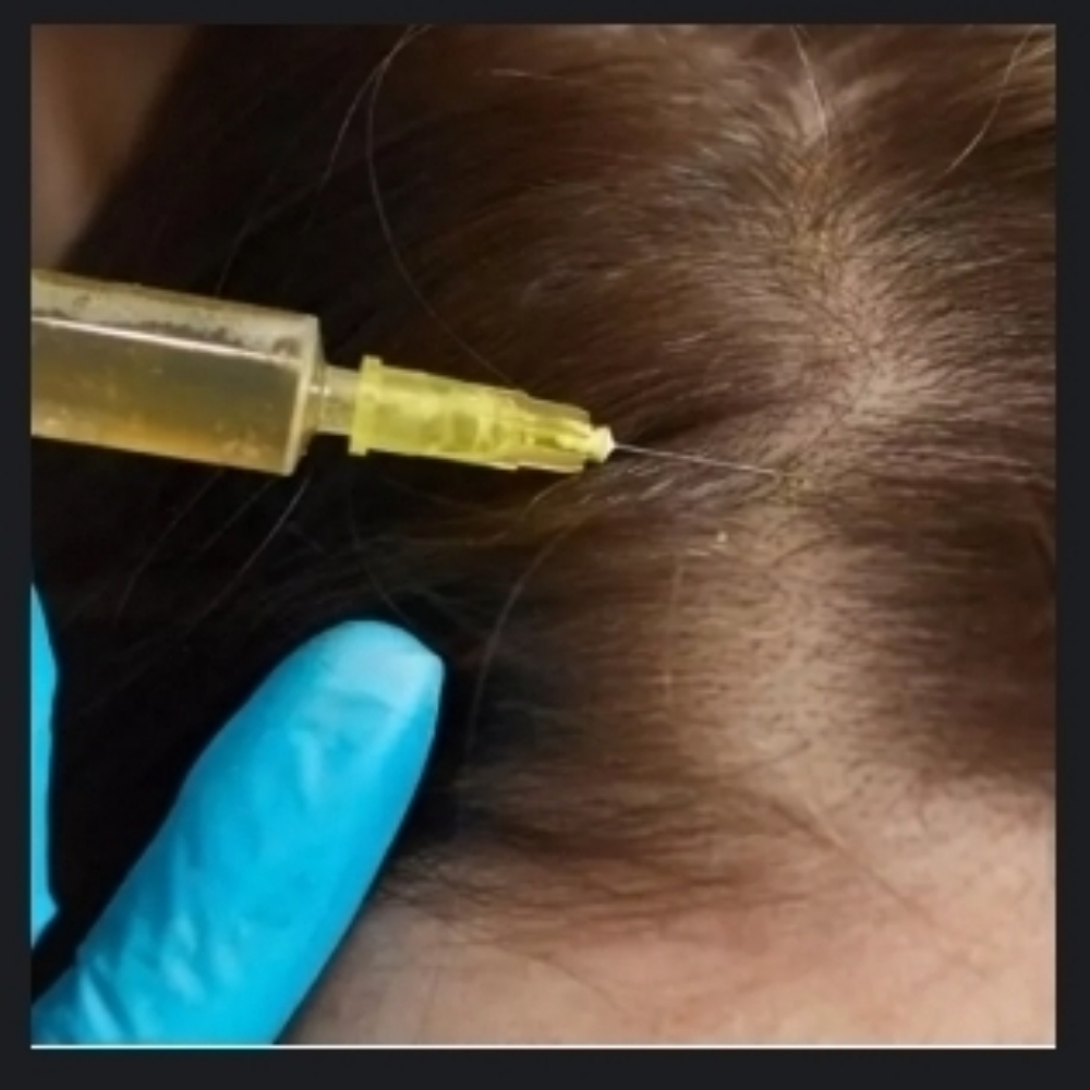 PRP Hair Restoration Injections at Skin & Toxx Medical Spa Westchase in Houston, TX