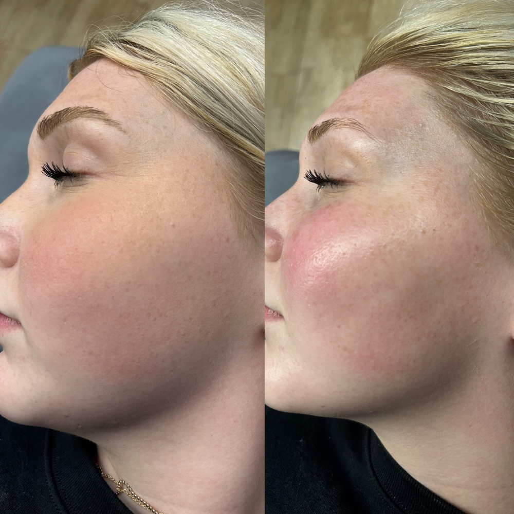 Dermaplane Hydrating Facial