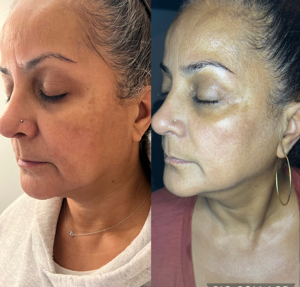 Reversing Time Nonsurgical Facelift