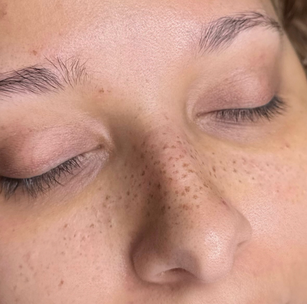 Freckles
