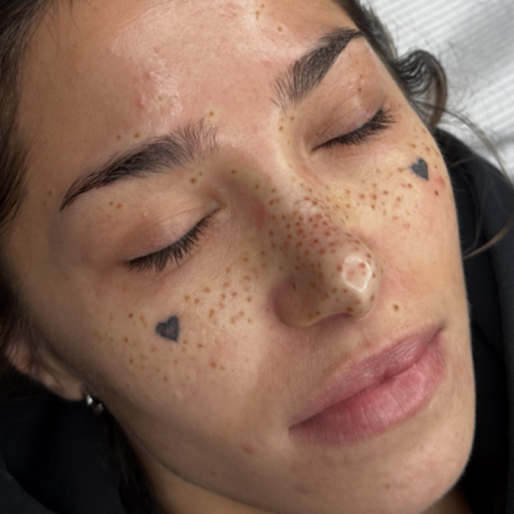Freckles at Inked by Sam Cosmetic Tattoo in Thousand Oaks, CA