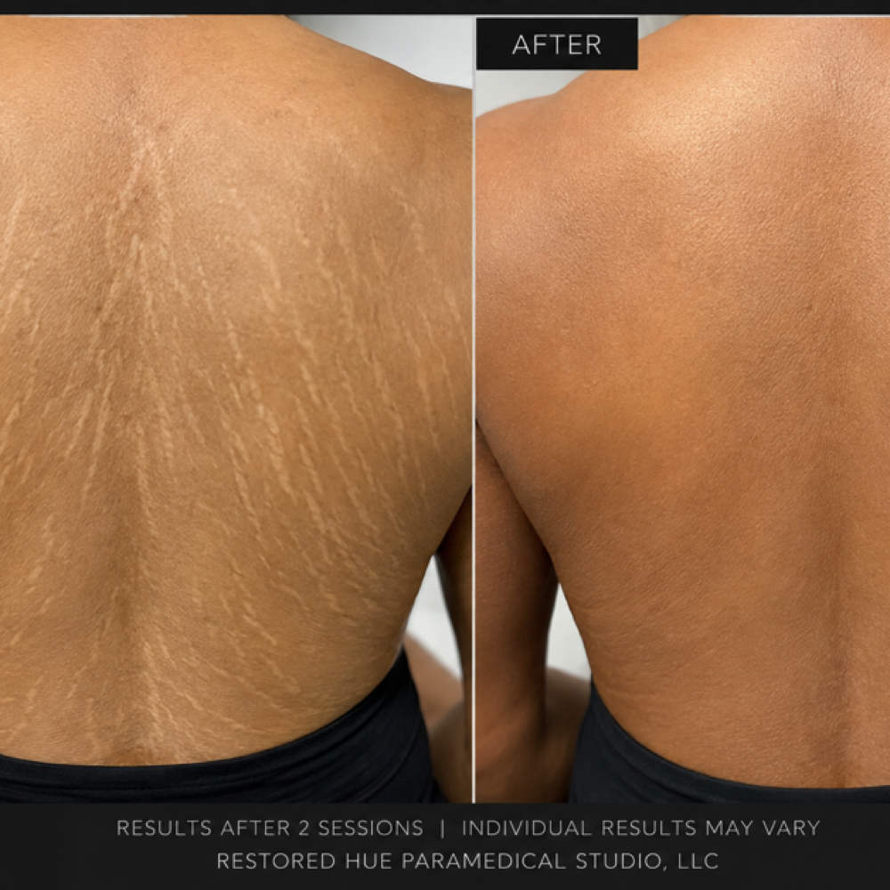 Back Stretch Mark Camouflage at Restored Hue Paramedical Studio in Atlanta, GA
