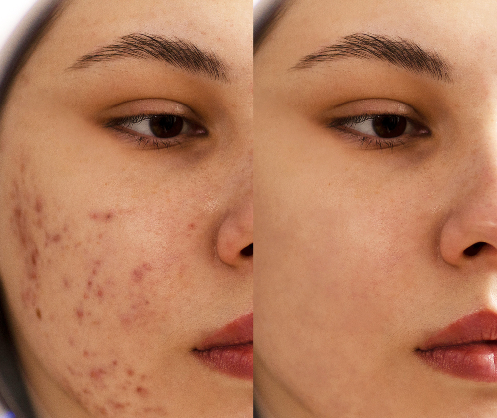 Signature Acne Facial at Alyvia Aesthetics in Shawnee, OK