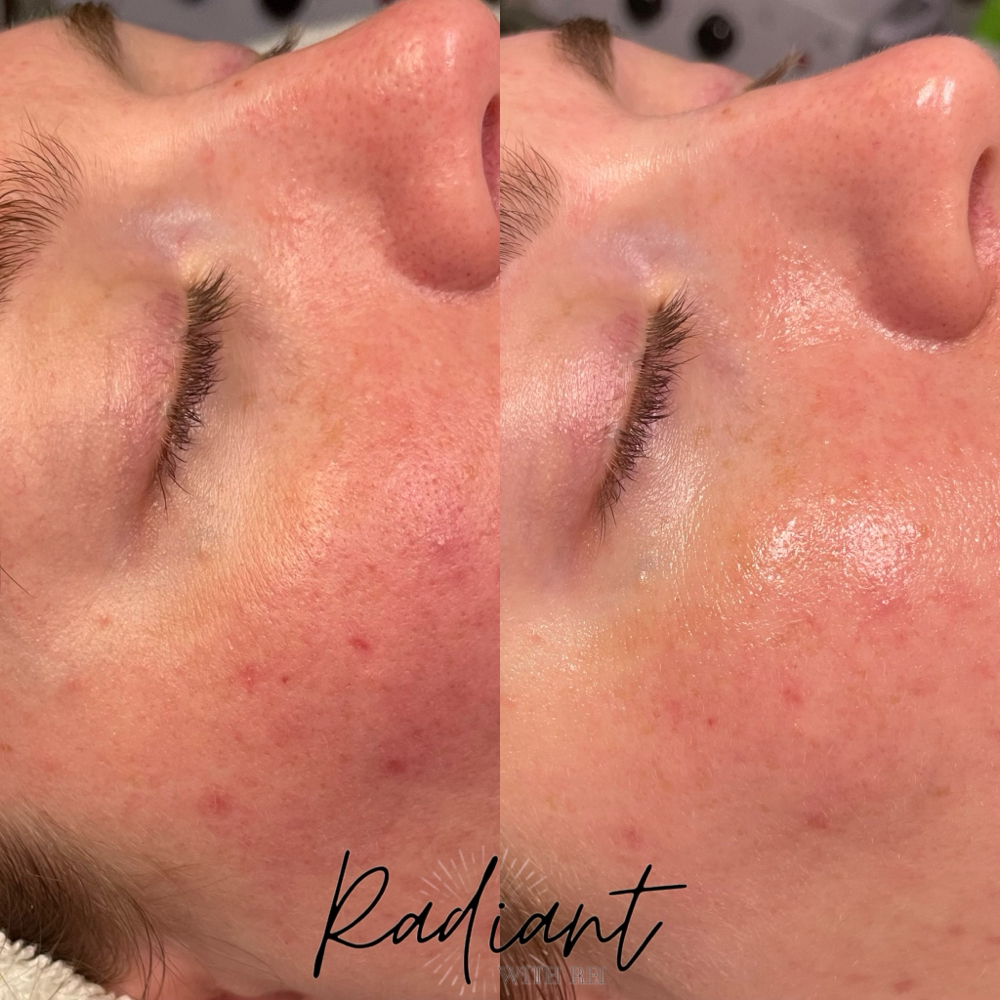 Chemical Peel Series Appointment