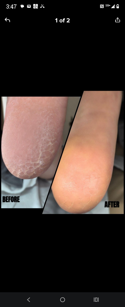 Intensive Callus Treatment Only