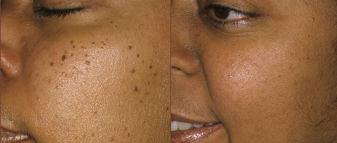 Skin Tag Removal
