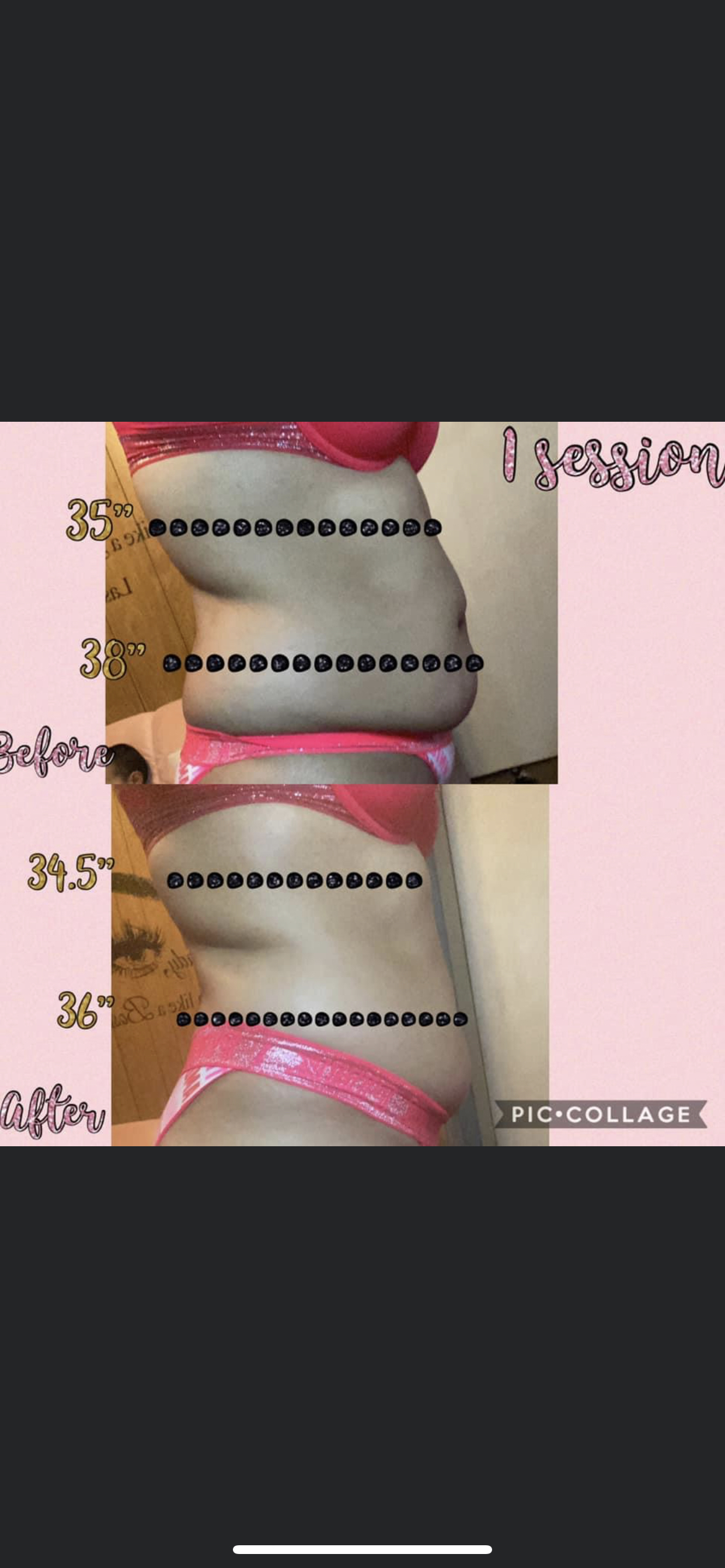 Body Contouring