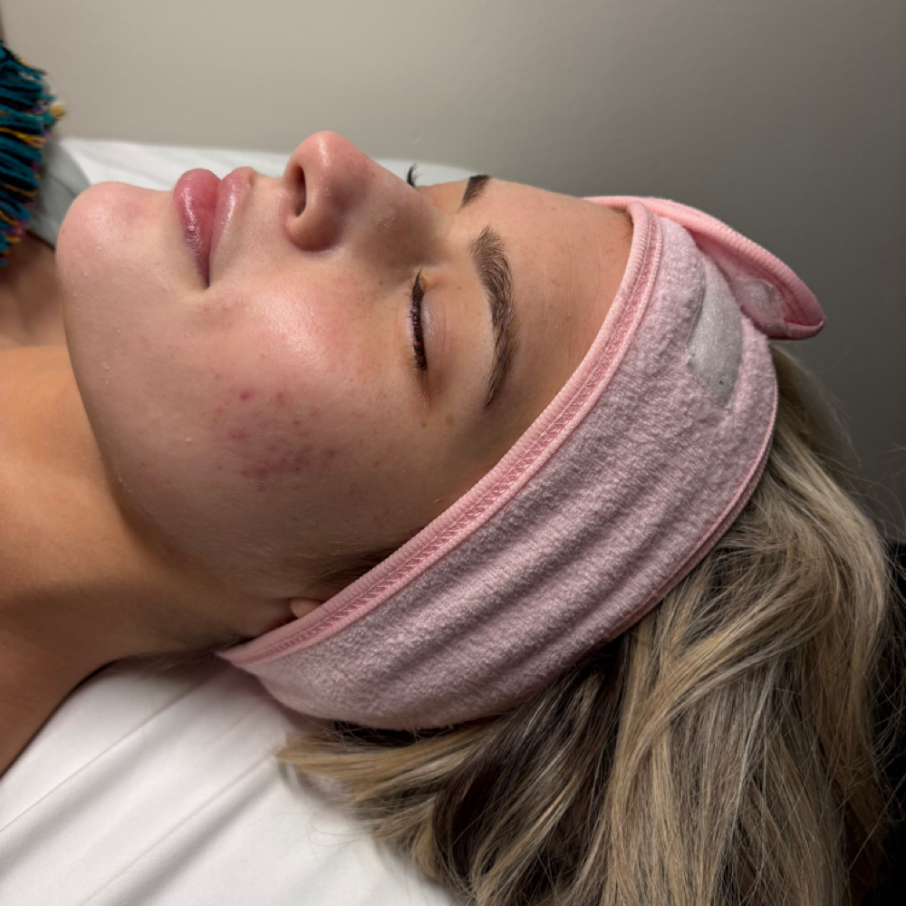 Acne Facial at Haleyskinbar in Weymouth, MA