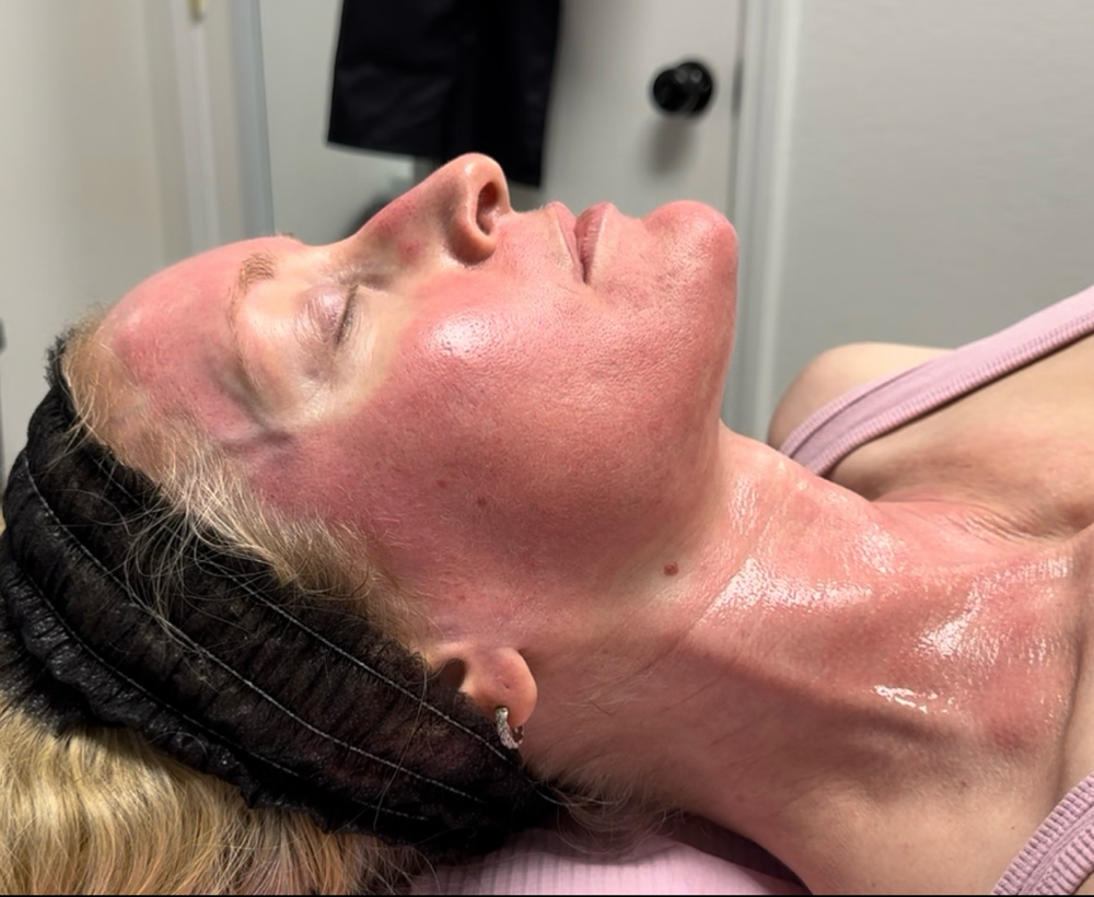 Microneedling