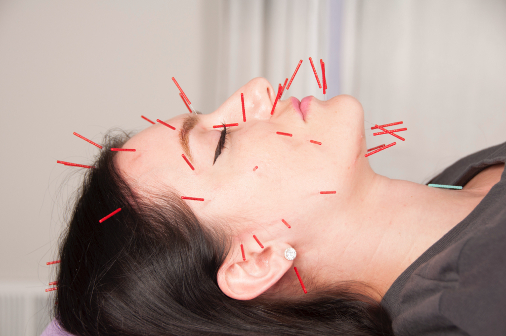 Facial Rejuvenation Cosmetic Acu at Acupuncture North in Minneapolis, MN