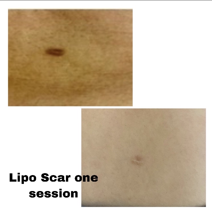 Lipo Scars