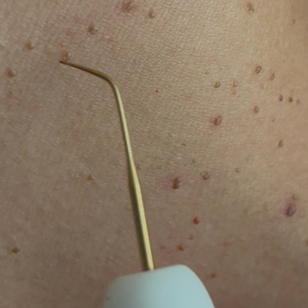 Skin Tag Removal at Acnessia Laser Clinic in Guaynabo, PR