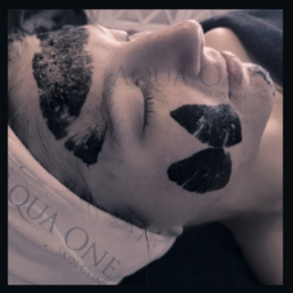 BioMicroneedling Level 4 at Aqua One Skin Clinic in Jasper, IN