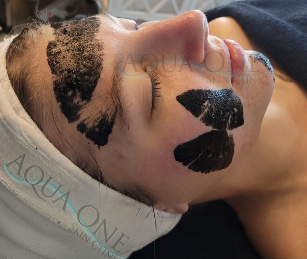 Bio-Microneedling Level 4