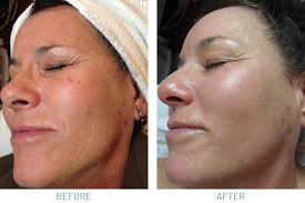 Micro Peel