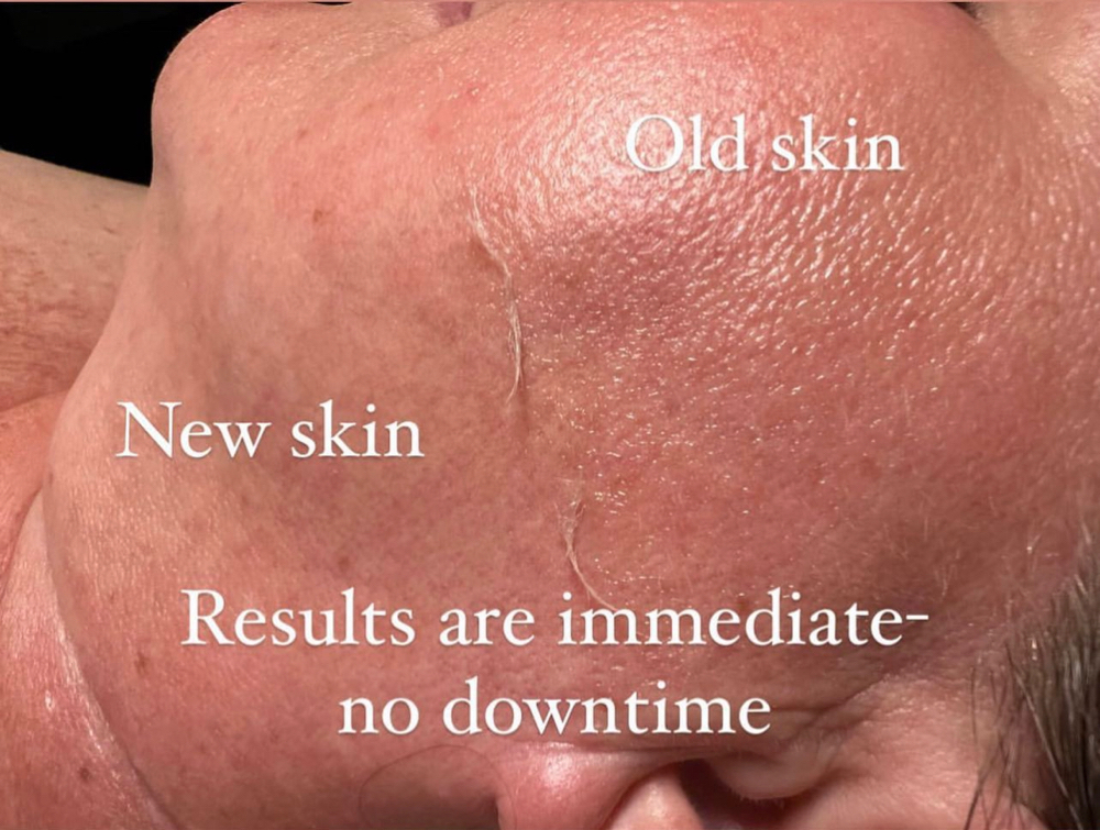 Dermaplaning (Non Facial)