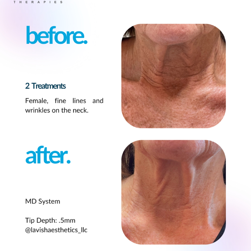 Procell Microchanneling at Livi Facial & Beauty Spa in Conway, AR