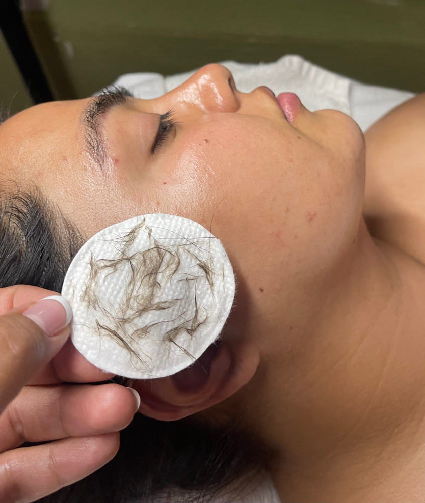 Dermaplane Facial