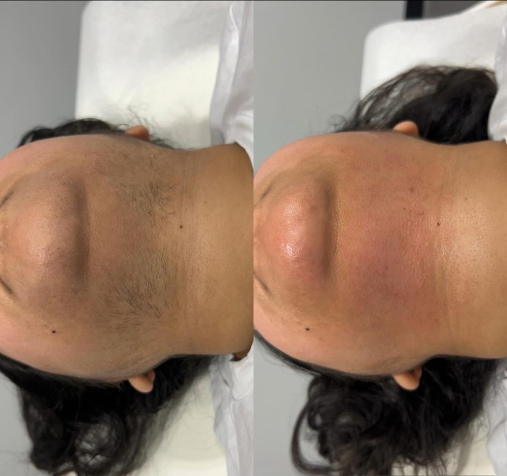 Chin Hair Removal at Yulee Mac Aesthetics in Tontitown, AR