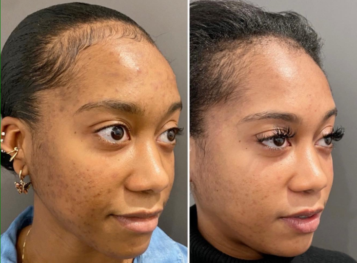 Chemical Peel