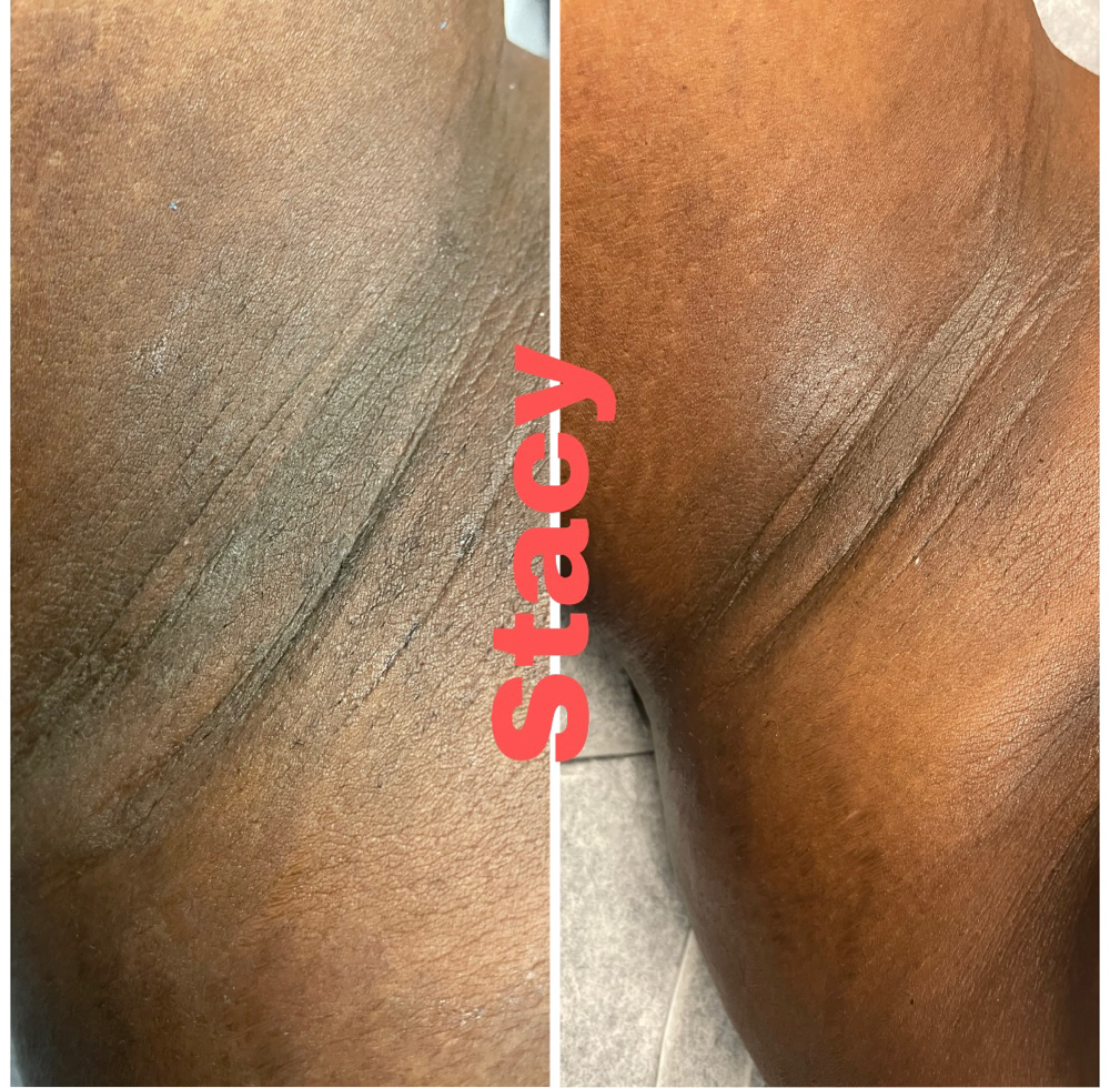 Extraction/Underarm Wax