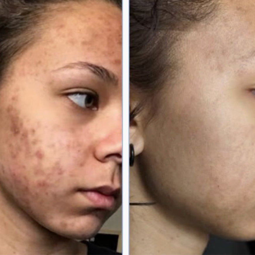 Marine Polishing Treatment at Bio Skin Aesthetics in Boise, ID