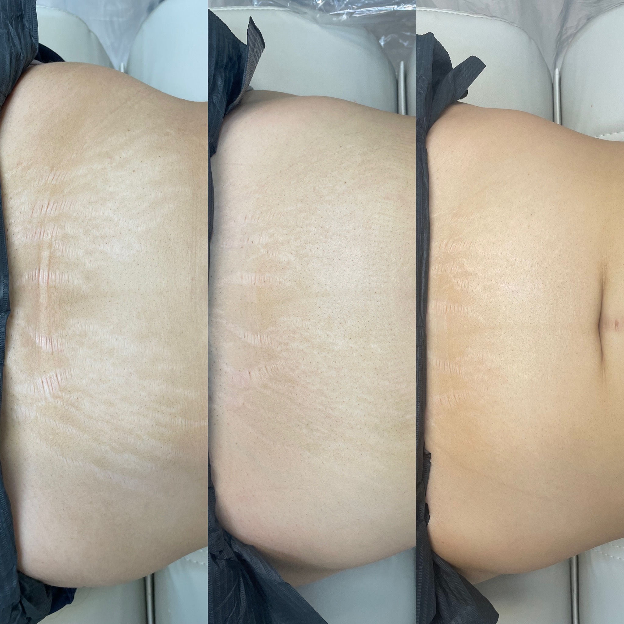 ISR: Stretch Mark Revision
