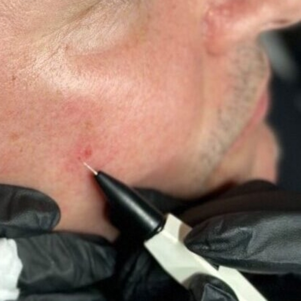 Electrolysis-Cheek Area (Model) at Majestic Aesthetics by jaki in Worthington, OH
