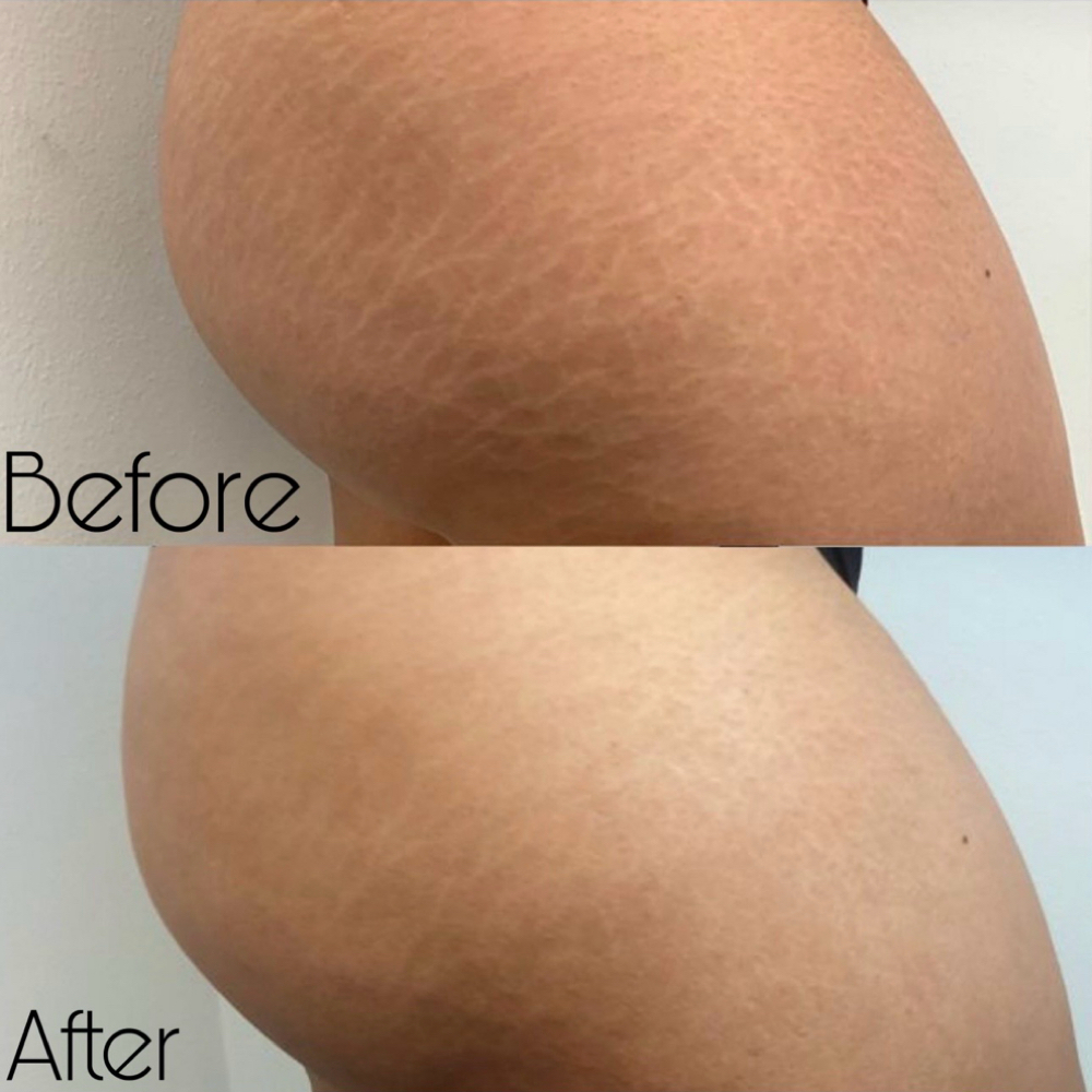 Scar & Stretch Mark Camouflage (Con