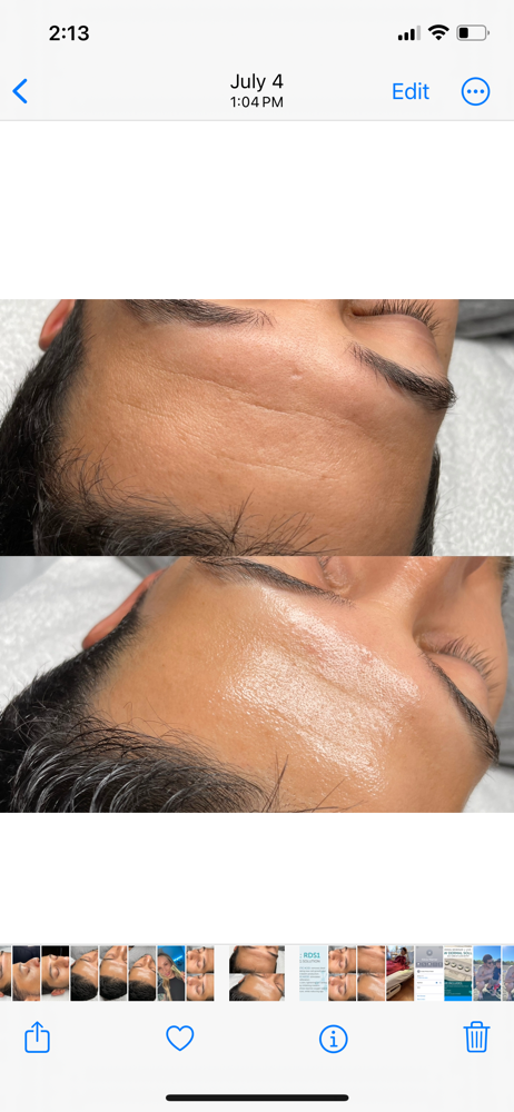 RDS Peel (Face) + Consult