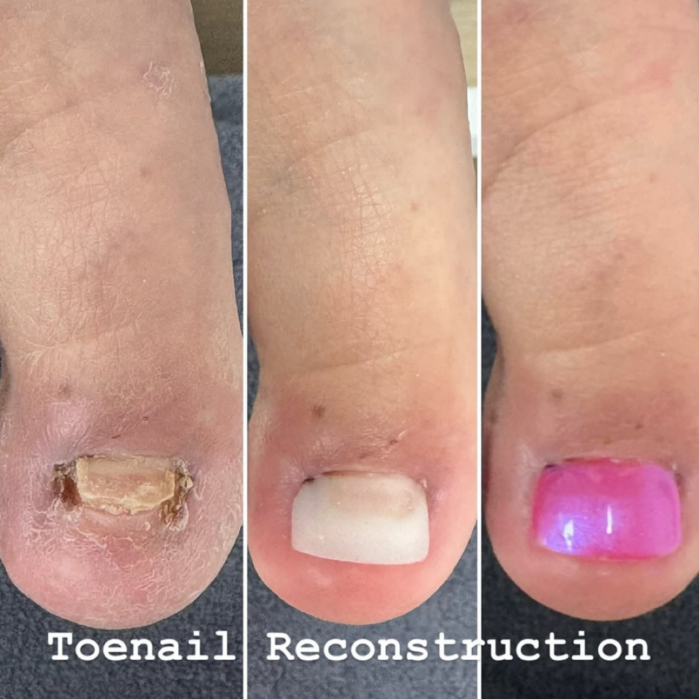 ToeNail Reconstruction at Southern Oregon PEDICURE CLINIC in Medford, OR