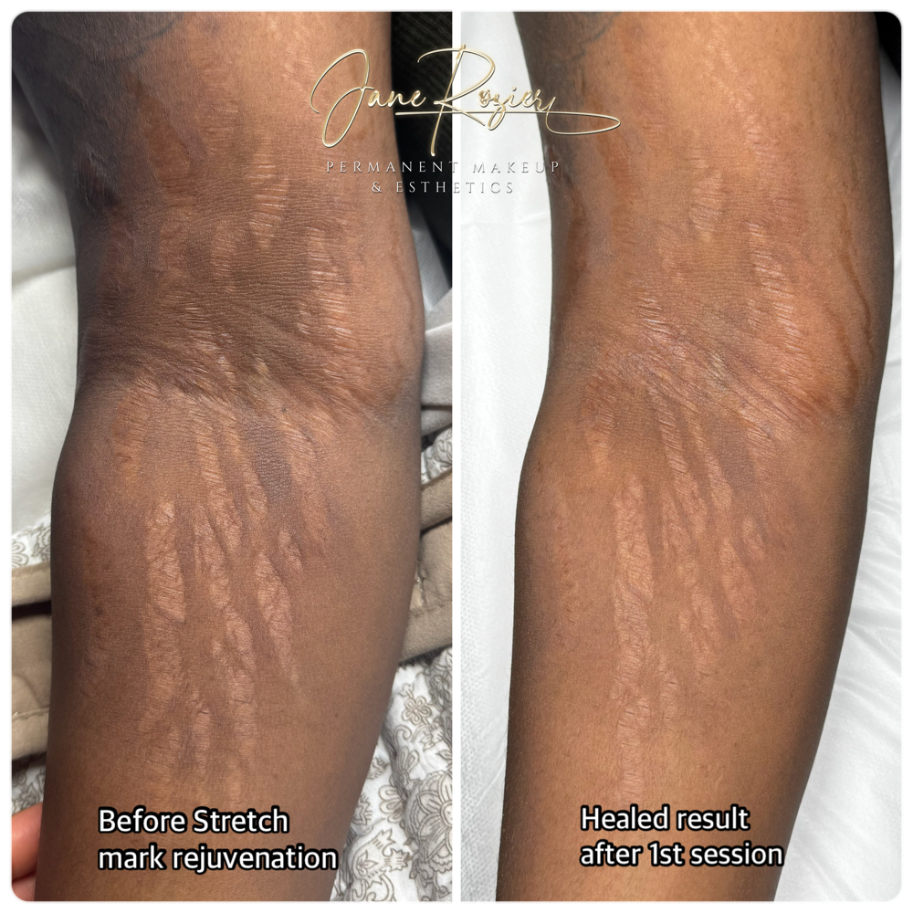 Inkless(stretch Mark) Pick 2 Areas at Jane Rozier Permanent Makeup & Esthetics in Bellevue, NE