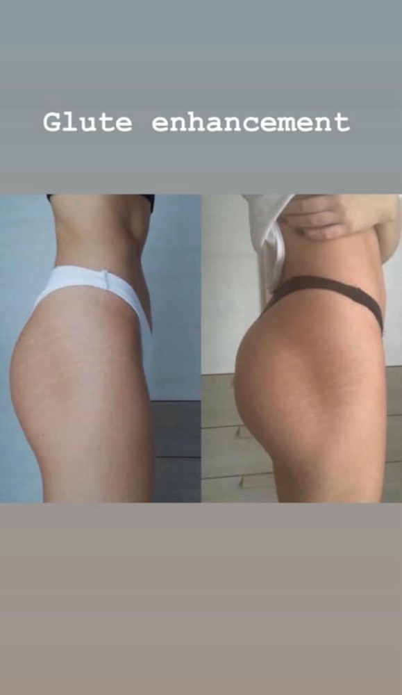 Glute Enhancement