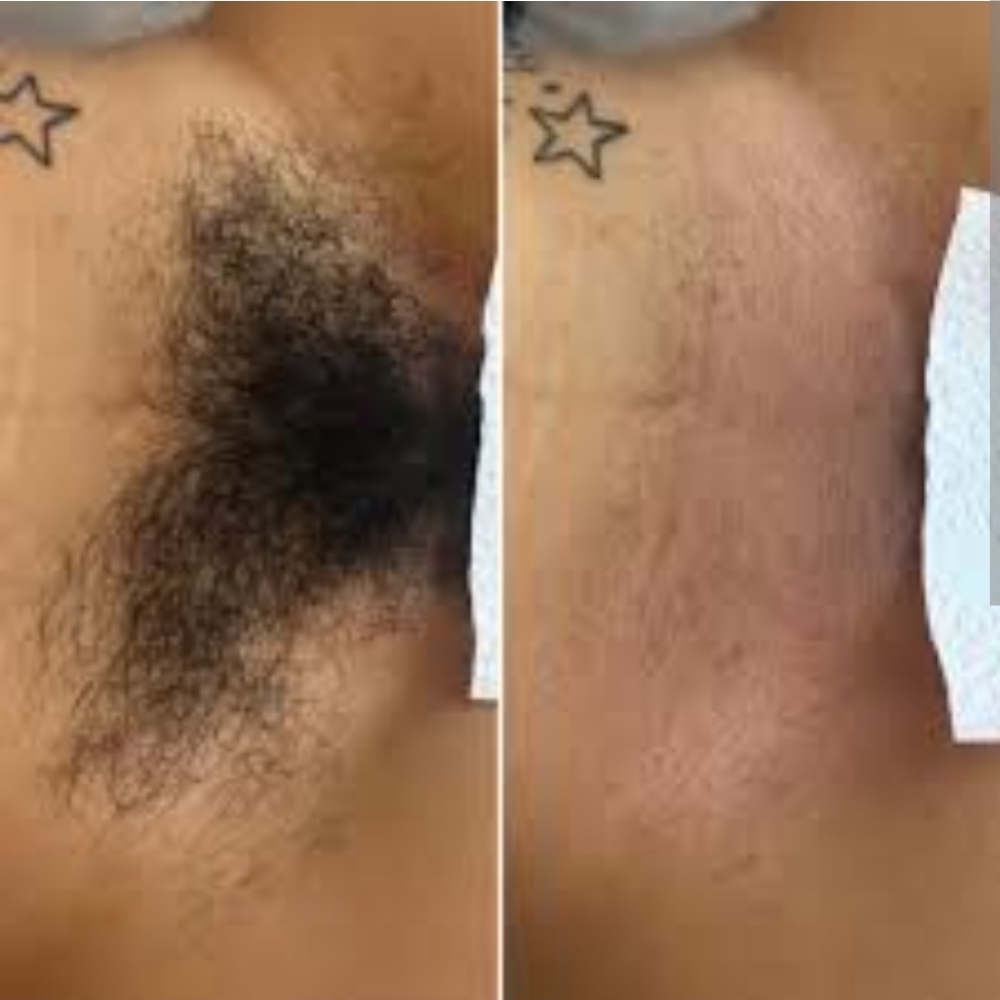 Brazilian Wax