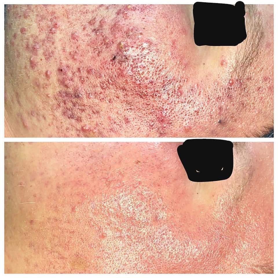 Acne Consultation And Treatment