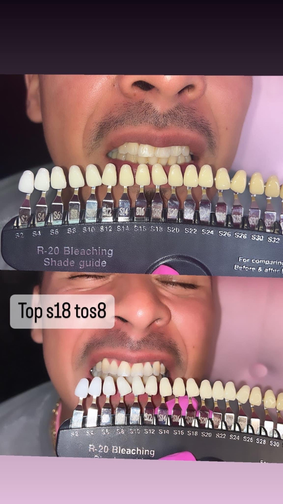 Teeth Whitening 30min