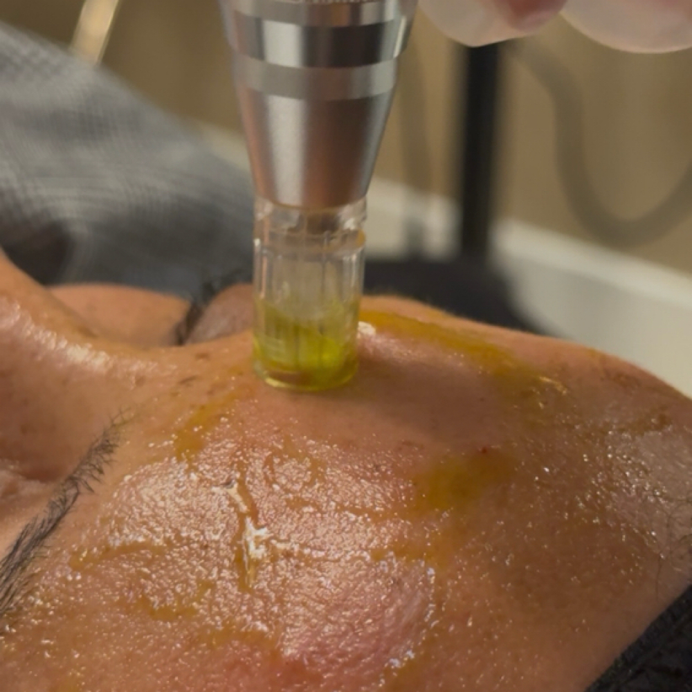 Microneedling Neck Add-On at Skin88 Studio in Beverly Hills, CA