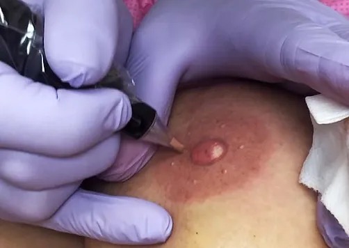Areola Restoration