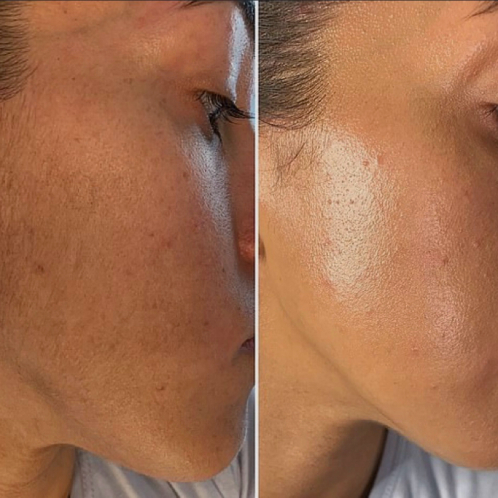 Dermaplane (Add On) at Rejuva Glow Beauty in Bethesda, MD